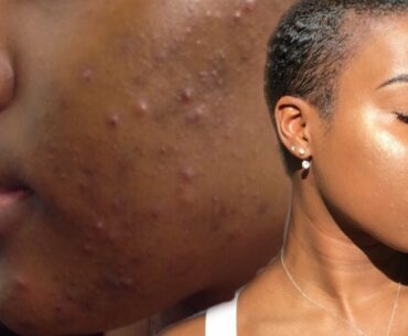 GET RID OF ACNE FAST WITH THESE TWO VITAMINS! |  Nia Hope