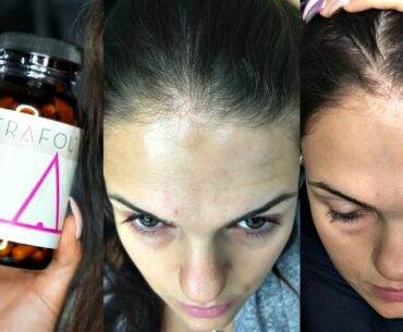 Nutrafol Hair Growth Testing & Review