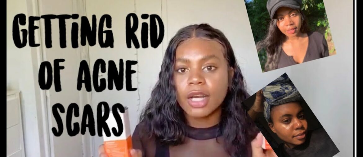 Getting rid of acne scars (USEFUL)