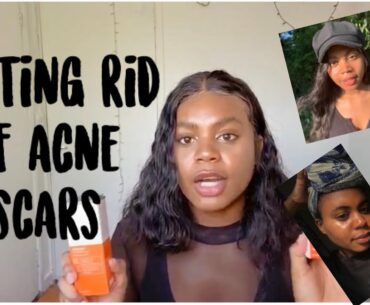 Getting rid of acne scars (USEFUL)