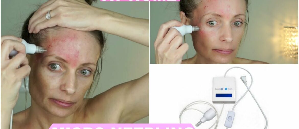 DERMINATOR MICRO NEEDLING | AT HOME MICRO NEEDLING MACHINE | OVER 40
