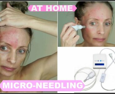 DERMINATOR MICRO NEEDLING | AT HOME MICRO NEEDLING MACHINE | OVER 40