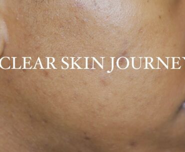 CLEAR SKIN JOURNEY I Vitamins for 30 Days I Week 1 UPDATE (WITH PICTURES)