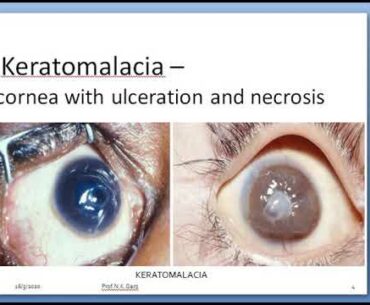 VITAMIN-A DEFICIENCY