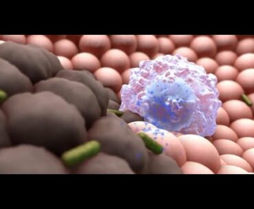 What Happens If You Get a Severe Case of COVID-19?