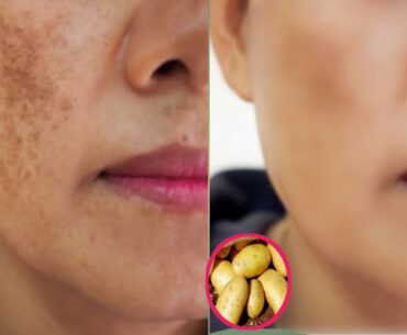 Vitamin E oil and potato beauty hacks !! get beautiful,  spotLess and glowing skin