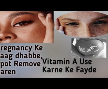 Vitamin a ke fayde| pregnancy Ke daag dhabbe spot remove Karen#Manish makeover#vitamin A