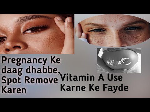 Vitamin a ke fayde| pregnancy Ke daag dhabbe spot remove Karen#Manish makeover#vitamin A