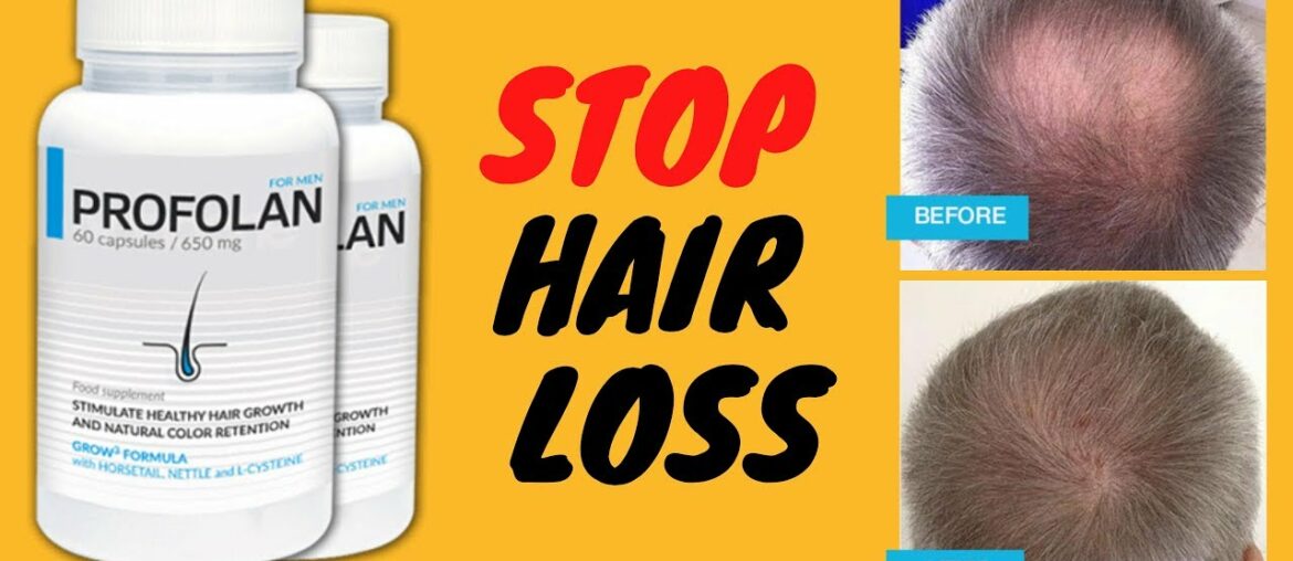 How to stop hair loss - Vitamin for hair loss - How to prevent hair loss - postpartum hair loss