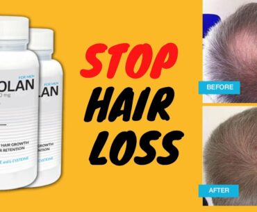 How to stop hair loss - Vitamin for hair loss - How to prevent hair loss - postpartum hair loss