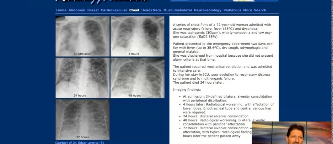 COVID 19 IS A BLOOD-NERVE DISEASE (Part 1: Do Vitamins D & C help?)