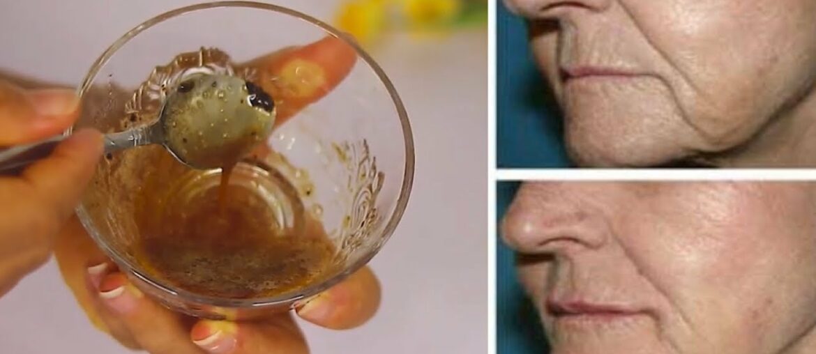 GET RID OF DEEP MOUTH WRINKLES VERY FAST