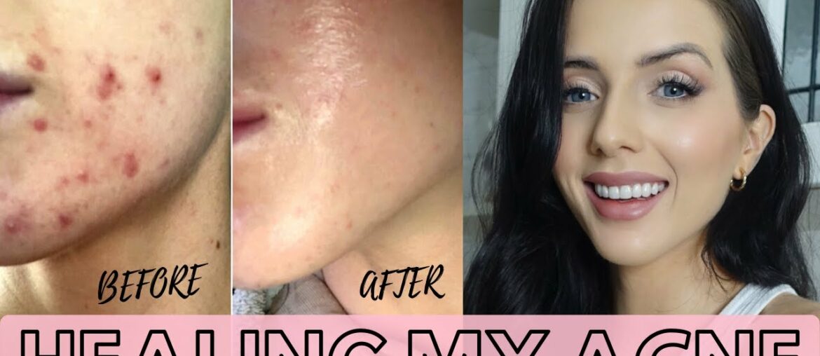 HEALING MY ADULT HORMONAL ACNE NATURALLY | My Skin Journey