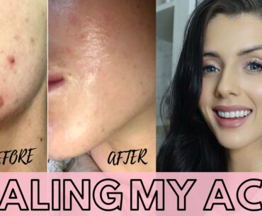 HEALING MY ADULT HORMONAL ACNE NATURALLY | My Skin Journey