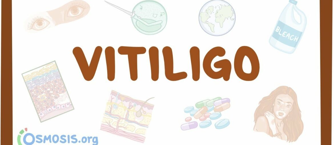 Vitiligo