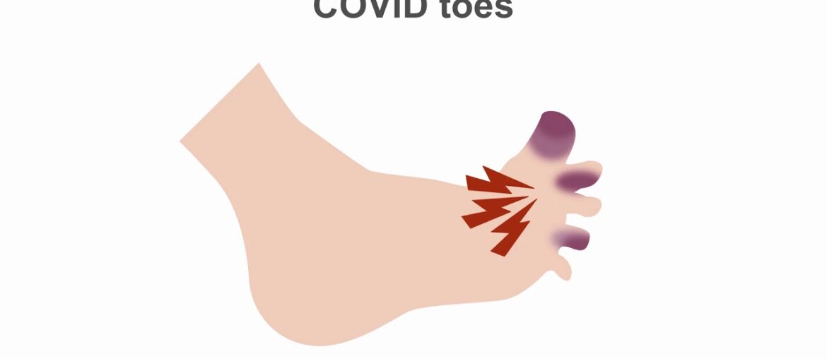 Appreciating potential complications of COVID-19