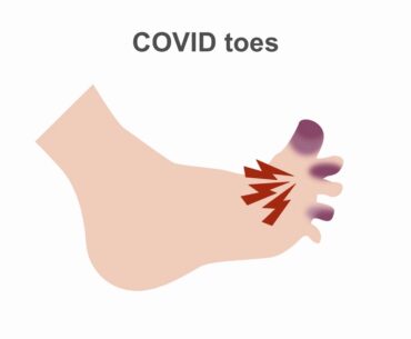 Appreciating potential complications of COVID-19