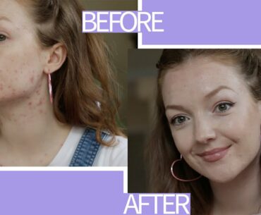 My Daily Makeup Routine | Acne Coverage