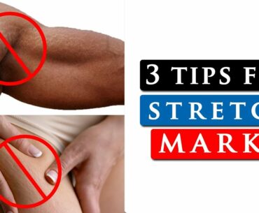 How to get rid of STRETCH MARKS on your SHOULDERS, LEGS & STOMACH