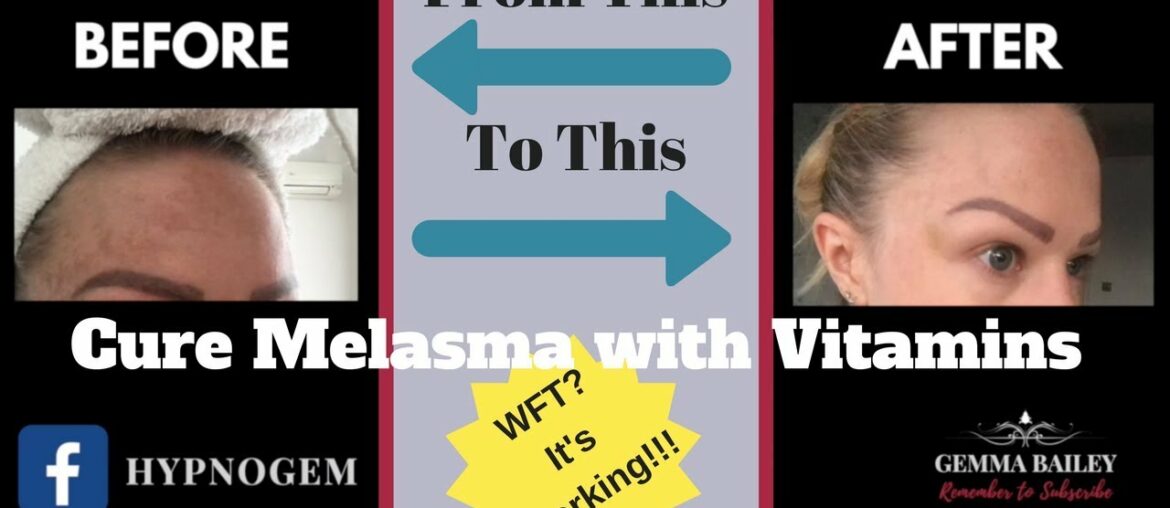 The Best Vitamins for Melasma