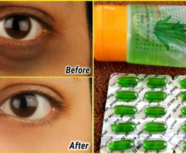 use vitamin E oil & aloevera gel to remove dark circles permanently