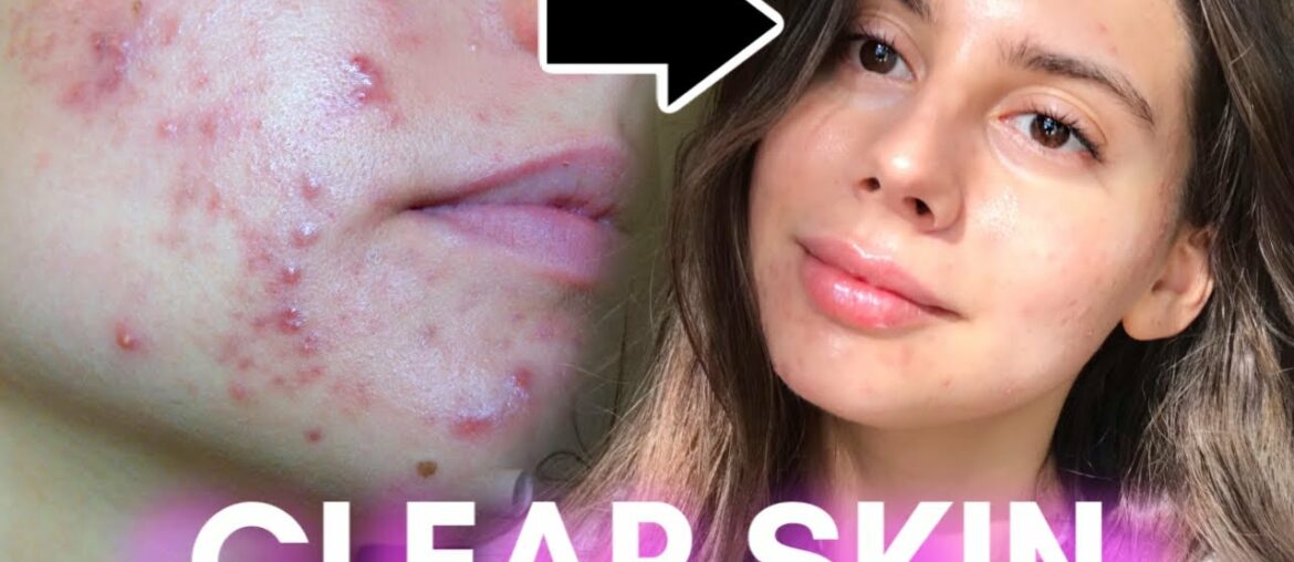 HOW TO GET CLEAR SKIN, GET RID OF ACNE || 2020 Skincare Routine!!