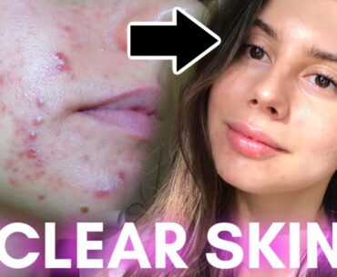 HOW TO GET CLEAR SKIN, GET RID OF ACNE || 2020 Skincare Routine!!