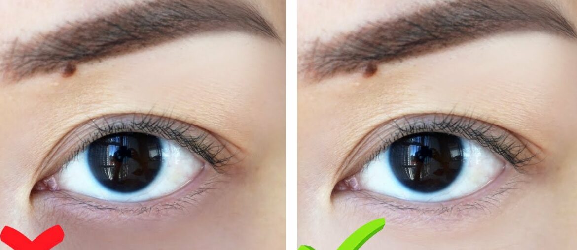 HOW TO: Get Rid Of Dark Circles WITHOUT MAKEUP!