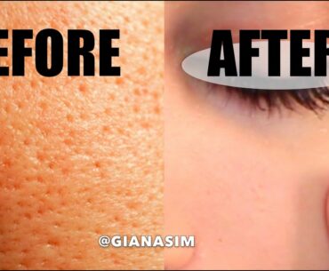 D.I.Y - Get rid of LARGE Pores NATURALLY! IT WORKS!