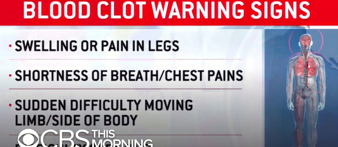 Doctors warn of potentially deadly blood clots in COVID-19 patients