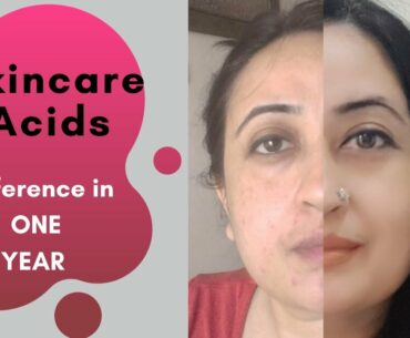 Glycolic Acids Plus 6 Skincare Acids | How to Use Acids in Skincare Routine |Anti-aging, fading scar