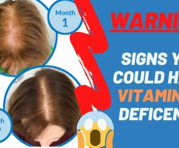 Top 11 Signs Of Vitamin D Deficiency - Must Watch | Daily Natural Cures