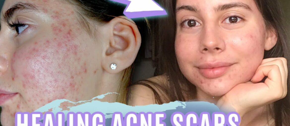 HEALING SCARS OVERNIGHT || MY ACNE SCAR EVENING SKINCARE ROUTINE 2020!!