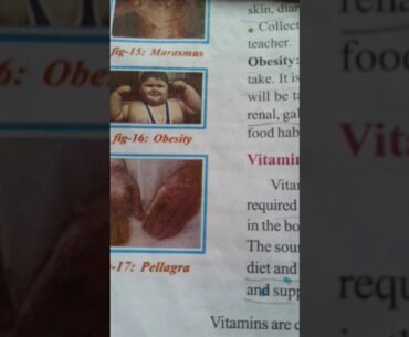 Vitamin deficiency diseases