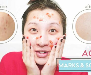 Remove Acne Marks, Hyperpigmentation & Scarring | Home Remedies + Natural Ingredients to Use