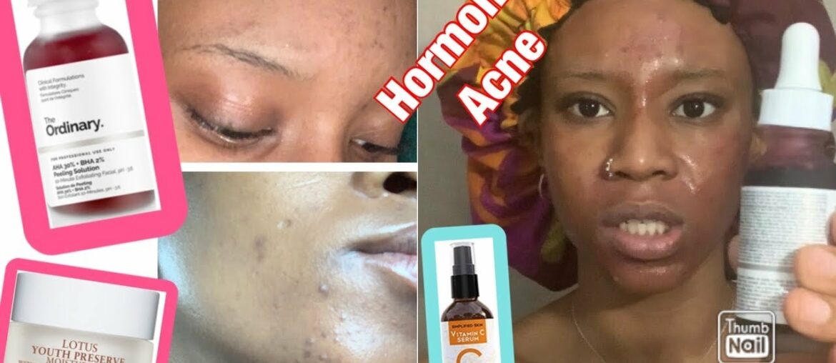 My morning skin care routine fading hyperpigmentation scars and treating hormonal acne| The Ordinary