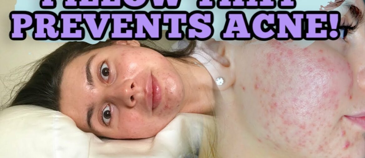 I TESTED ONE MONTH AN ANTI-AGING PILLOW THAT PREVENTS ACNE! || HERE ARE MY THOUGHTS!!