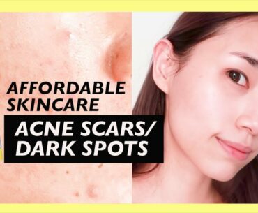 Affordable Skincare for Acne Scars, Dark Spots, Pores & Brighter Skin!