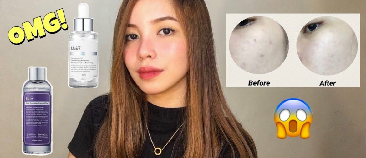 PAANO NAWALA PIMPLE MARKS KO?? | Klairs freshly juiced vitamin drop & unscented toner