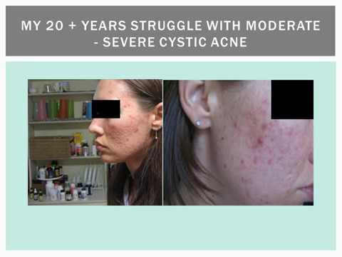 Vitamin Supplements for Cystic Acne