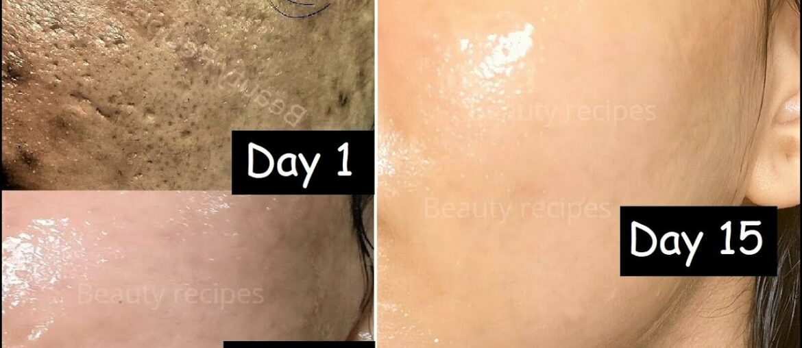 15 Days Skin Repair | Close Large OPEN PORES & Remove Dark Spots - RiceWater Icecubes & Vitamin C