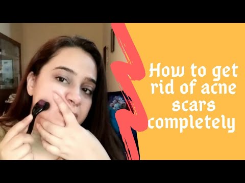 How to get rid of acne scars completely