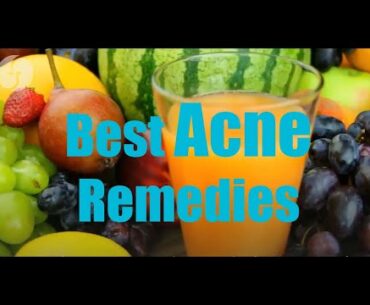 Acne Treatments Naturally | Natural Treatments for Acne | Best Acne Remedies