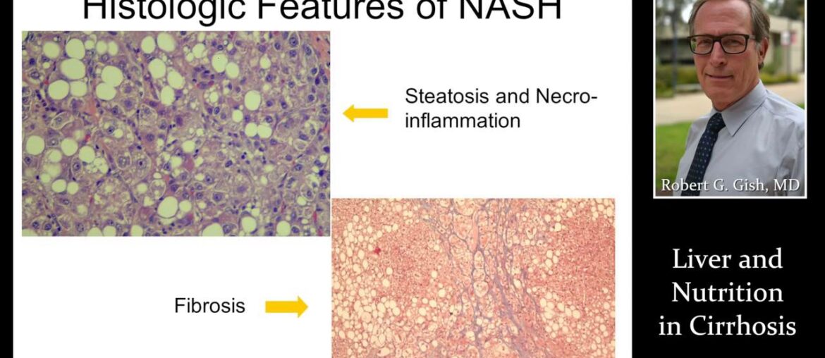 LIVER & NUTRITION IN CIRRHOSIS by Dr. Robert Gish