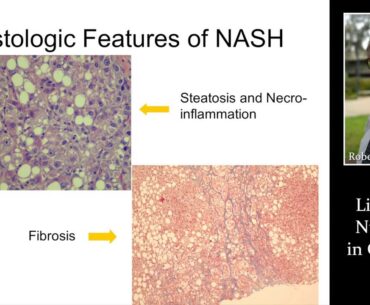 LIVER & NUTRITION IN CIRRHOSIS by Dr. Robert Gish