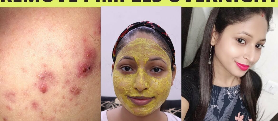 How To Remove Pimples Overnight | Best Acne Treatment at home | Megha's Beauty Land