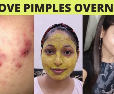 How To Remove Pimples Overnight | Best Acne Treatment at home | Megha's Beauty Land