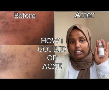 HOW I GOT RID OF ACNE/SCARRING/HYPER-PIGMENTATION WITH ORDINARY/ BODY SHOP/BOOTS PRODUCTS | NAIMAK.