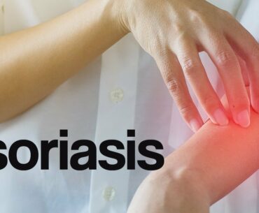 Psoriasis Overview & Management