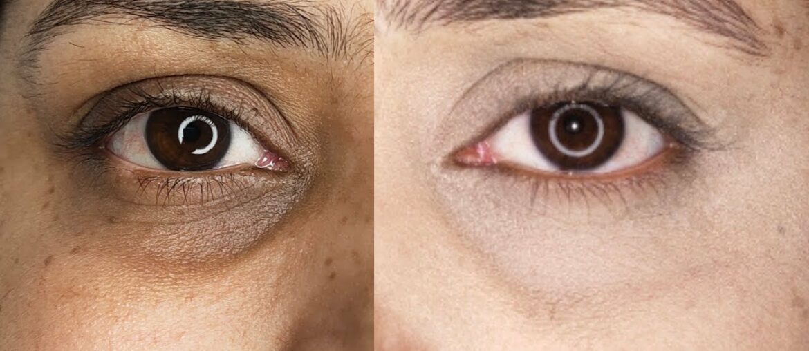 How To Remove Dark Circles Naturally At Home Quickly